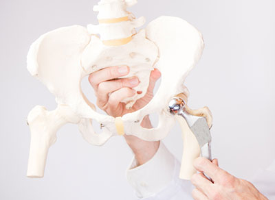 Cirugía de prótesis de cadera en Zaragoza