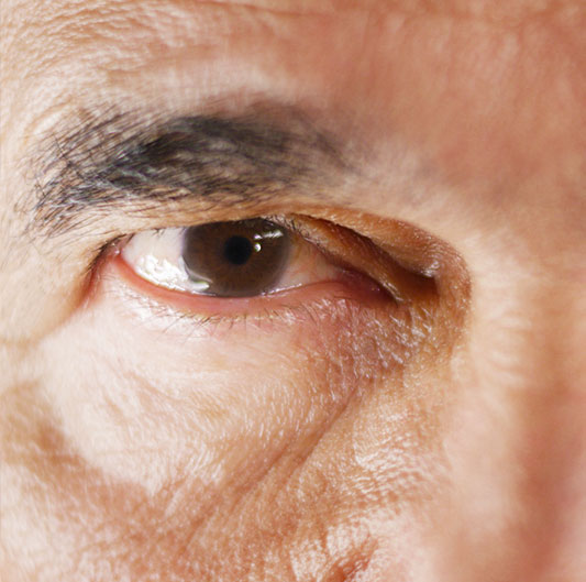 El exceso de piel puede llegar a interferir en el campo visual