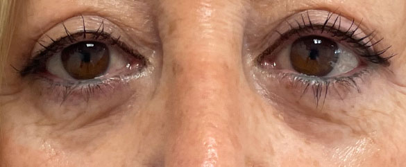 Después de la Blefaroplastia