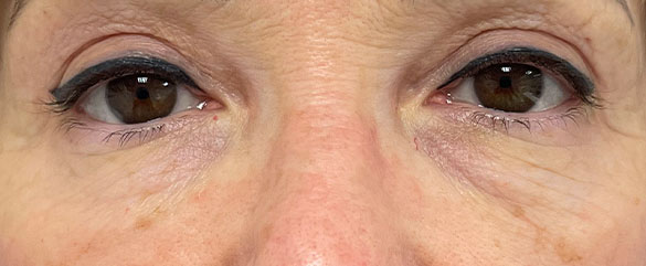 Después de la Blefaroplastia