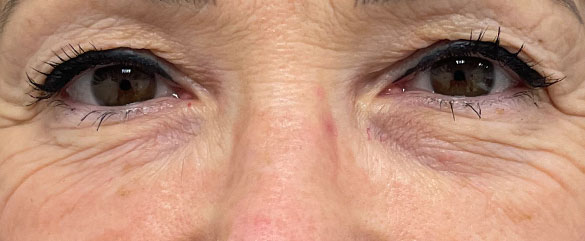 Antes de la Blefaroplastia