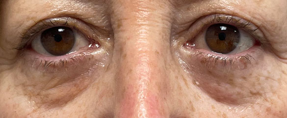 Antes de la Blefaroplastia