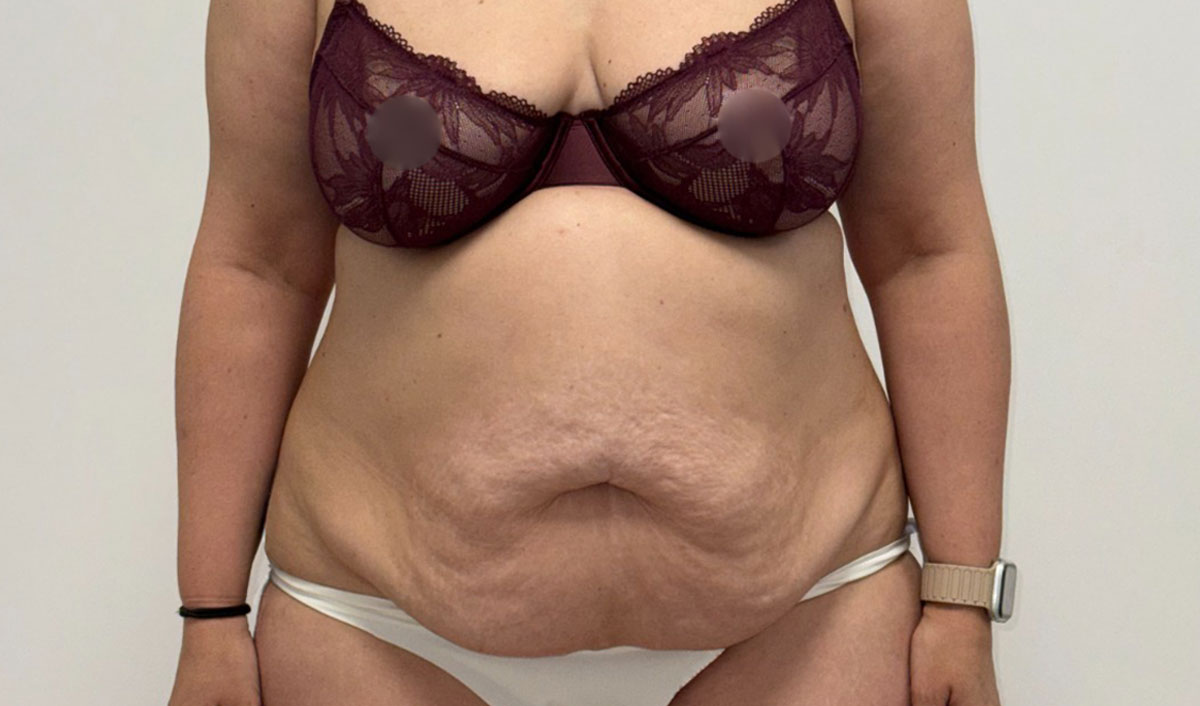 Antes de la cirugía de abdomen