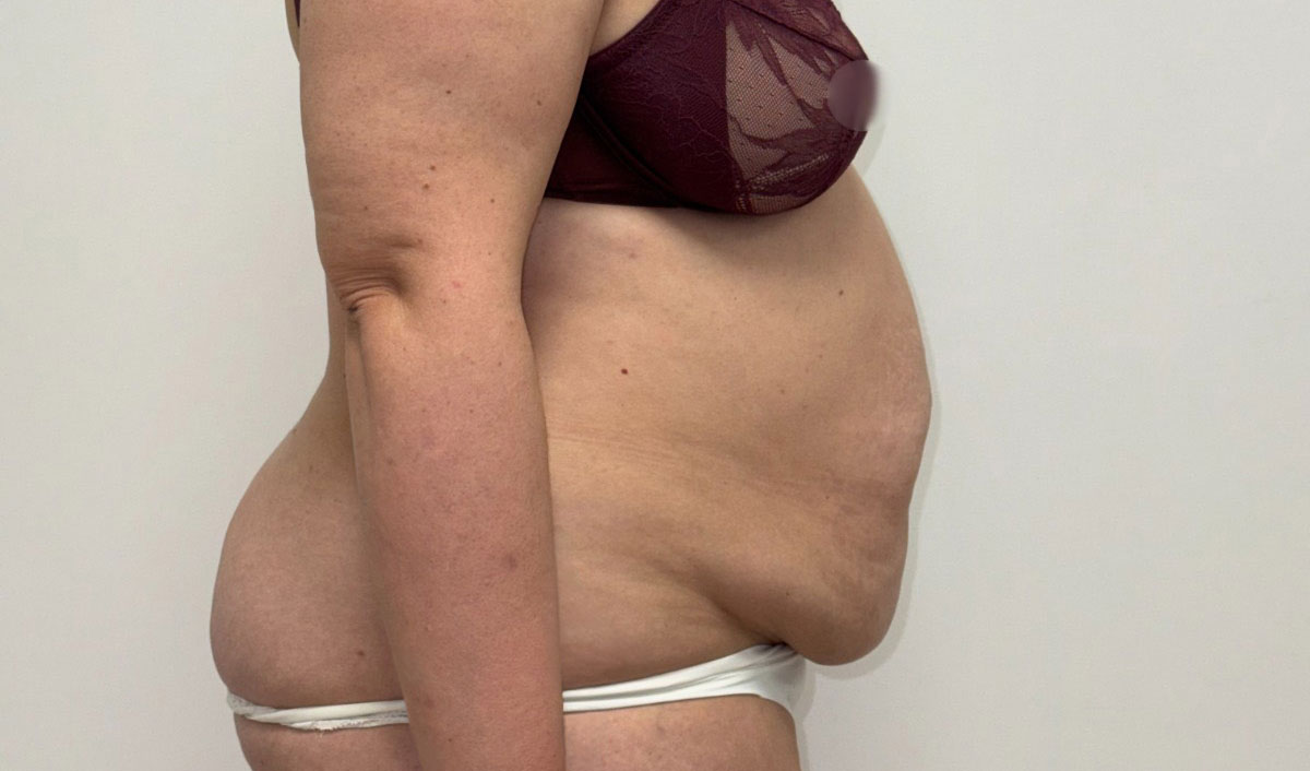Antes de la cirugía de abdomen