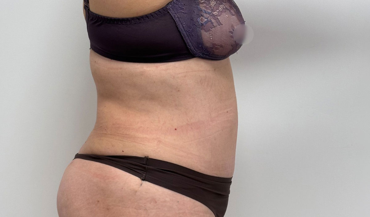 Después de la cirugía de abdomen